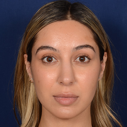 Female Rhinoplasty