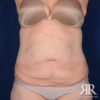 Tummy Tuck