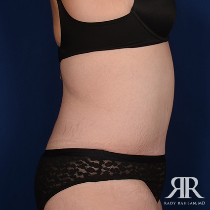 Tummy Tuck