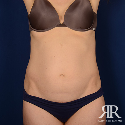 Tummy Tuck