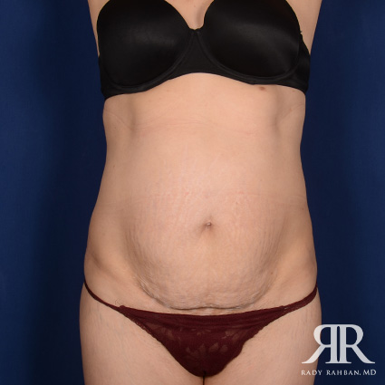 Tummy Tuck