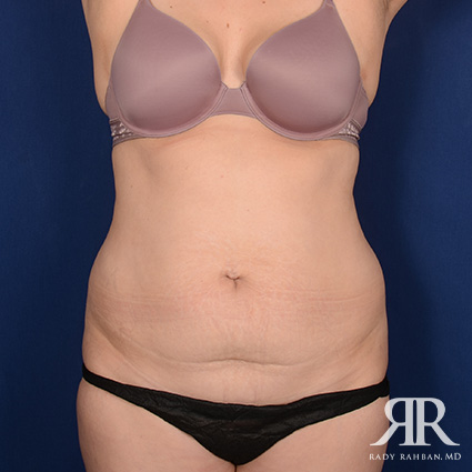 Tummy Tuck