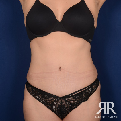 Tummy Tuck