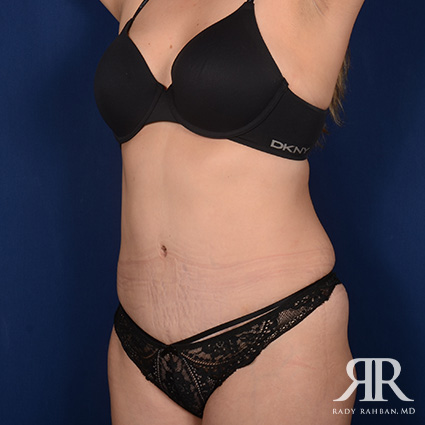 Tummy Tuck