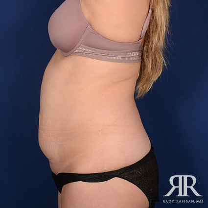 Tummy Tuck