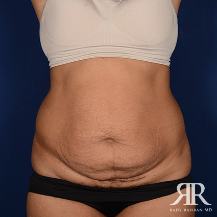 Tummy Tuck