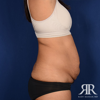 Tummy Tuck