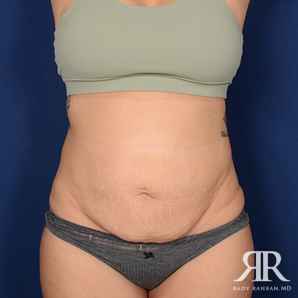 Tummy Tuck