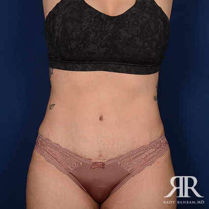 Tummy Tuck