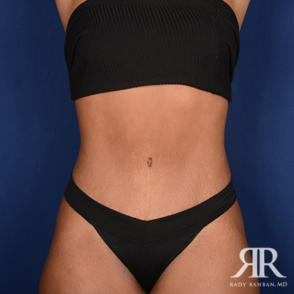 Tummy Tuck