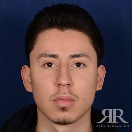 Male Rhinoplasty