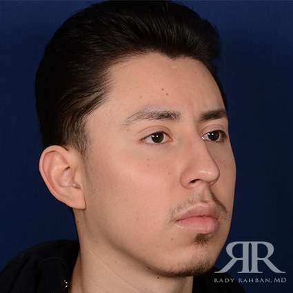 Male Rhinoplasty