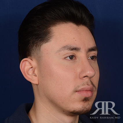 Male Rhinoplasty