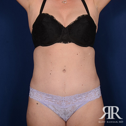 Tummy Tuck