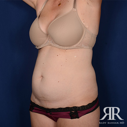 Tummy Tuck