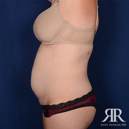 Tummy Tuck