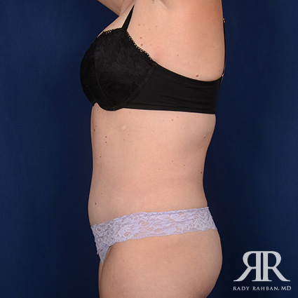 Tummy Tuck