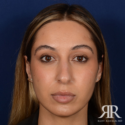 Female Rhinoplasty