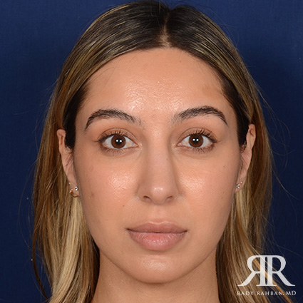 Female Rhinoplasty