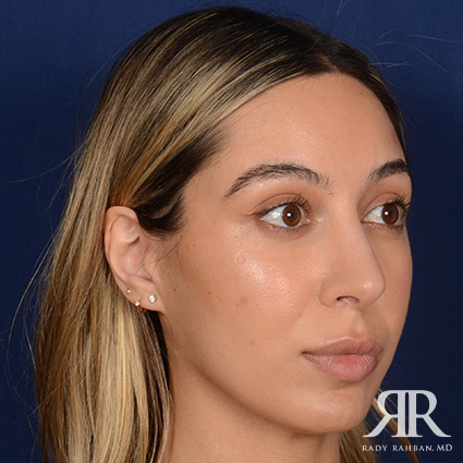 Female Rhinoplasty