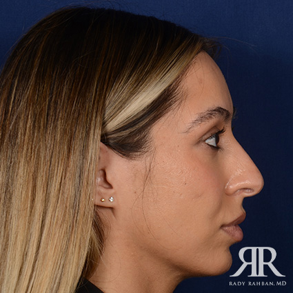 Female Rhinoplasty