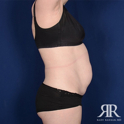 Tummy Tuck