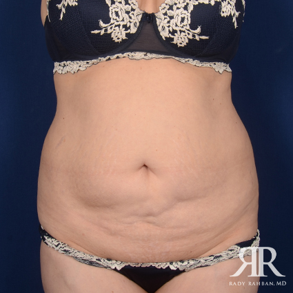 Tummy Tuck