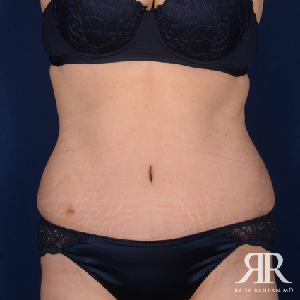 Tummy Tuck