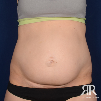 Tummy Tuck