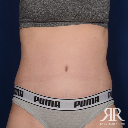 Tummy Tuck