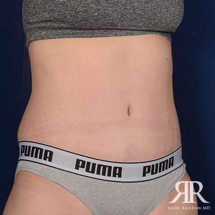 Tummy Tuck