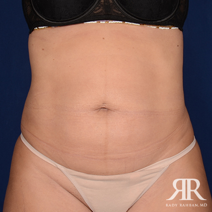 Tummy Tuck