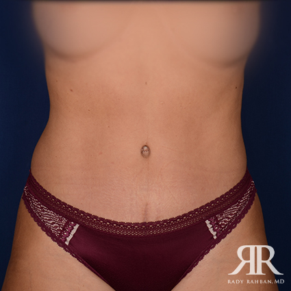 Tummy Tuck