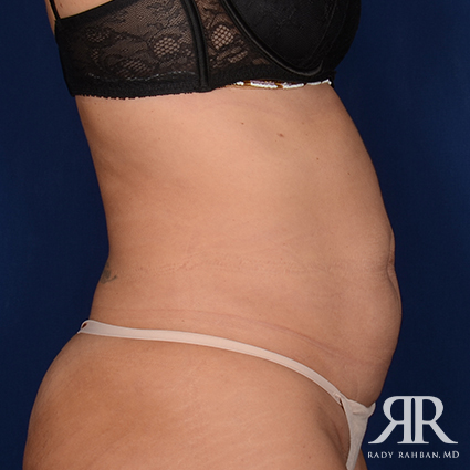 Tummy Tuck