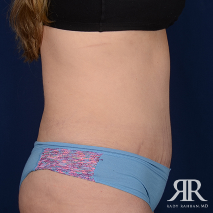 Severe Diastasis Recti