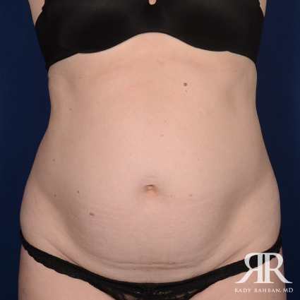 Tummy Tuck