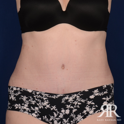 Tummy Tuck