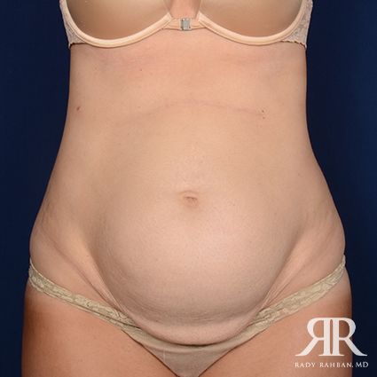 Tummy Tuck