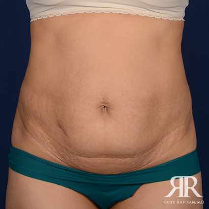 Tummy Tuck