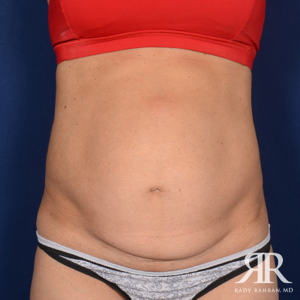 Severe Diastasis Recti