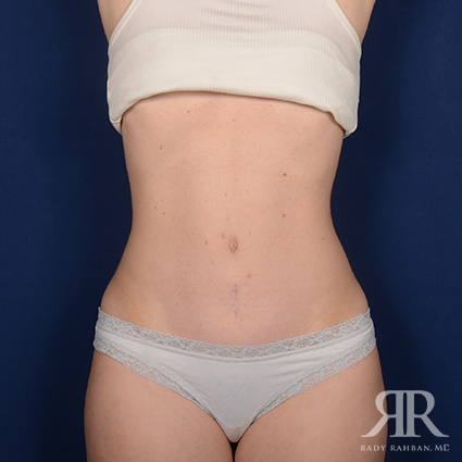 Tummy Tuck