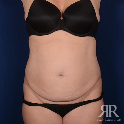 Tummy Tuck