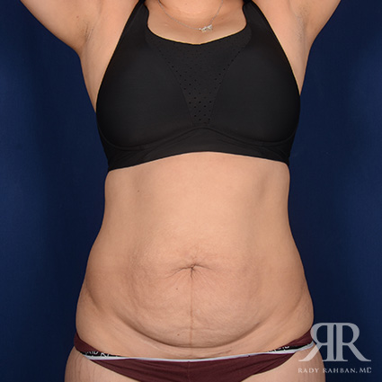 Tummy Tuck