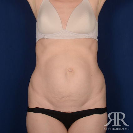 Tummy Tuck