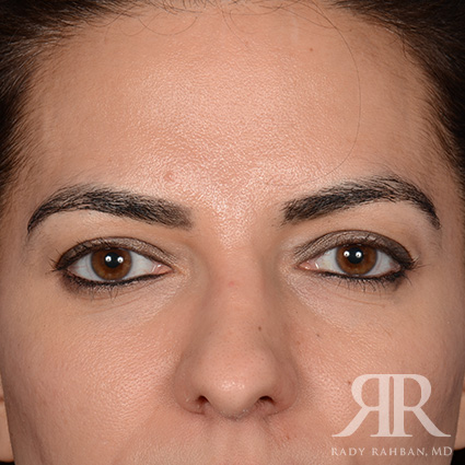Browlift