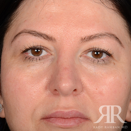 Eyelid Surgery