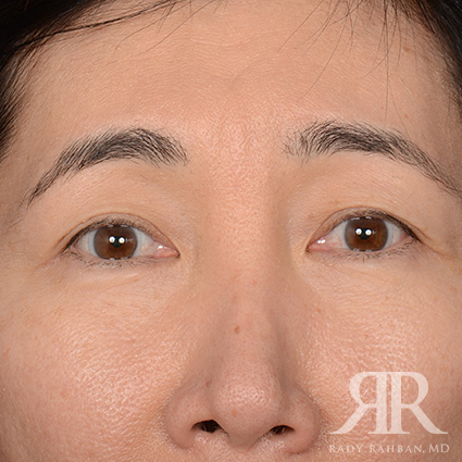 Eyelid Surgery