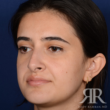 Female Rhinoplasty