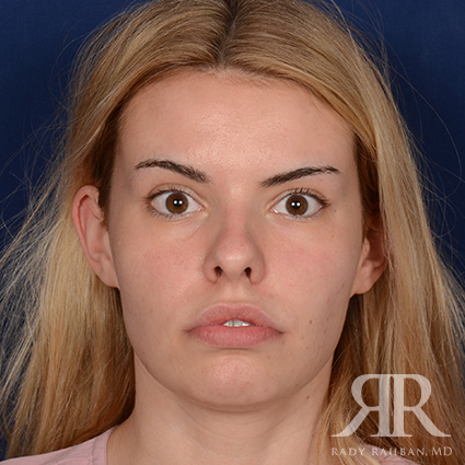 Female Rhinoplasty