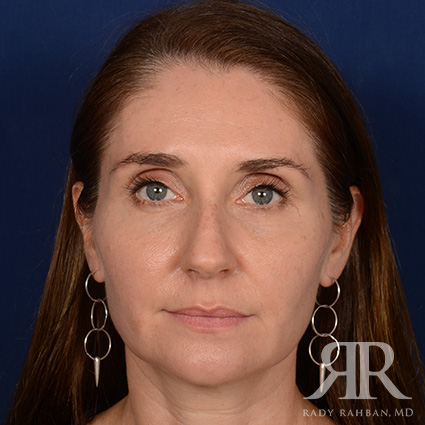 Female Rhinoplasty